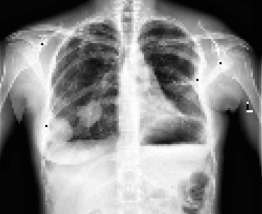 AI Detection of Cardiomegaly in Chest X-ray