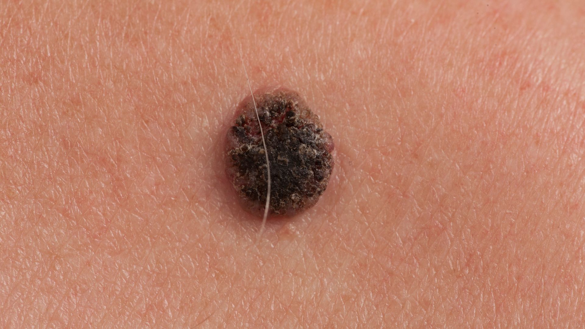 Skin Cancer