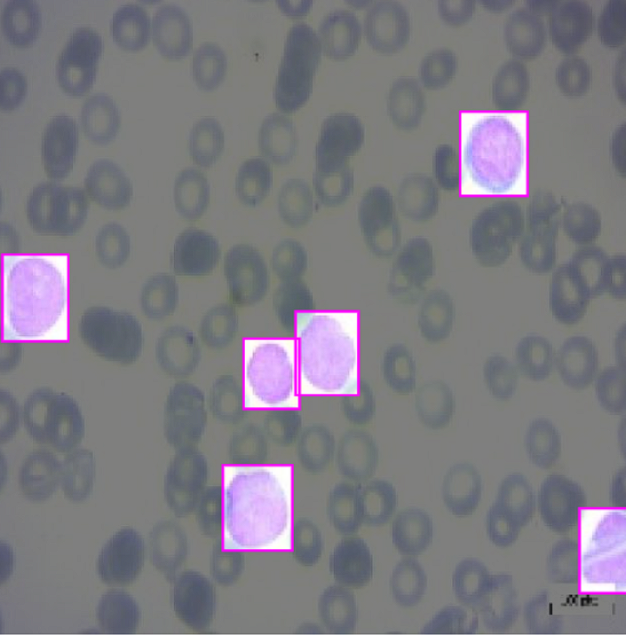 Blood Cancer Detection Example 1