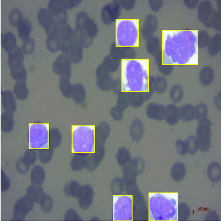 Blood Cancer Detection Example 2