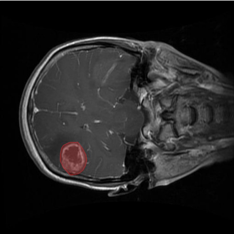 Brain Tumour segmentation