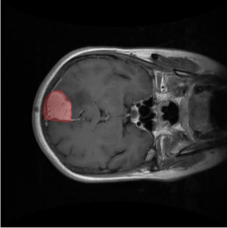 Brain Tumor Segmentation Example 1