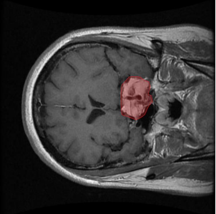 Brain Tumor Segmentation Example 2