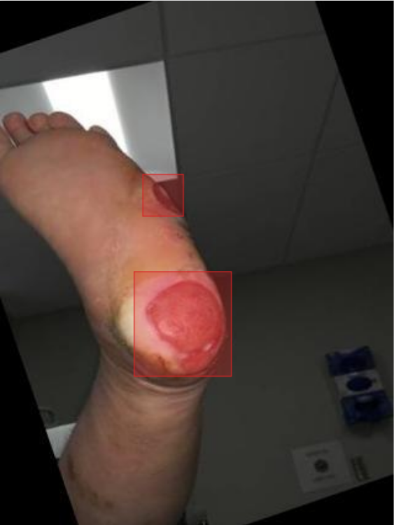 Wound Detection Example