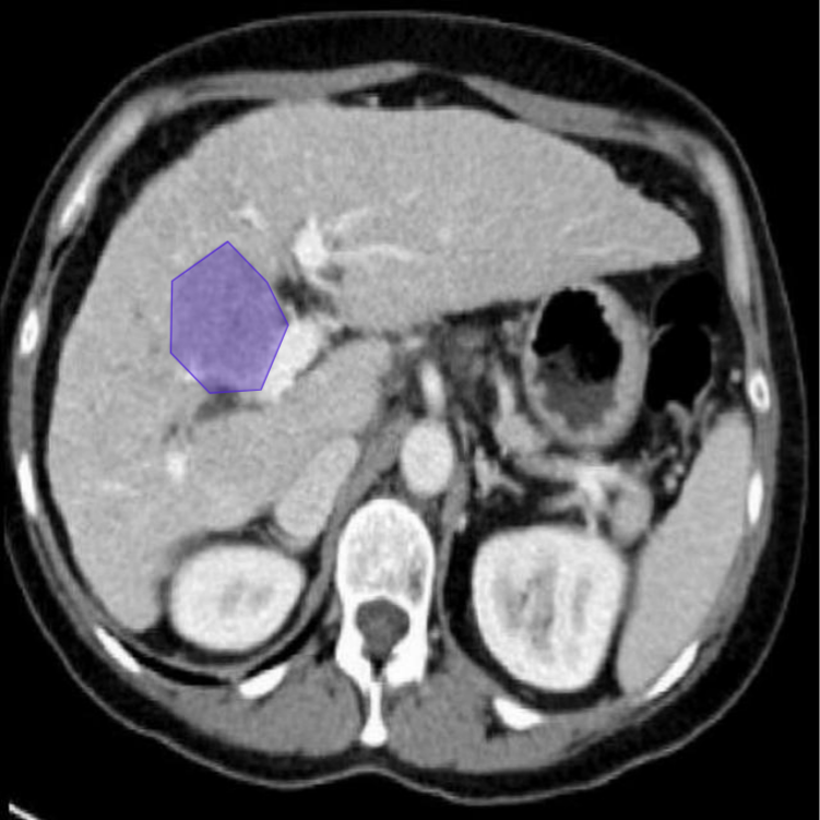 Liver Segmentation Example 2