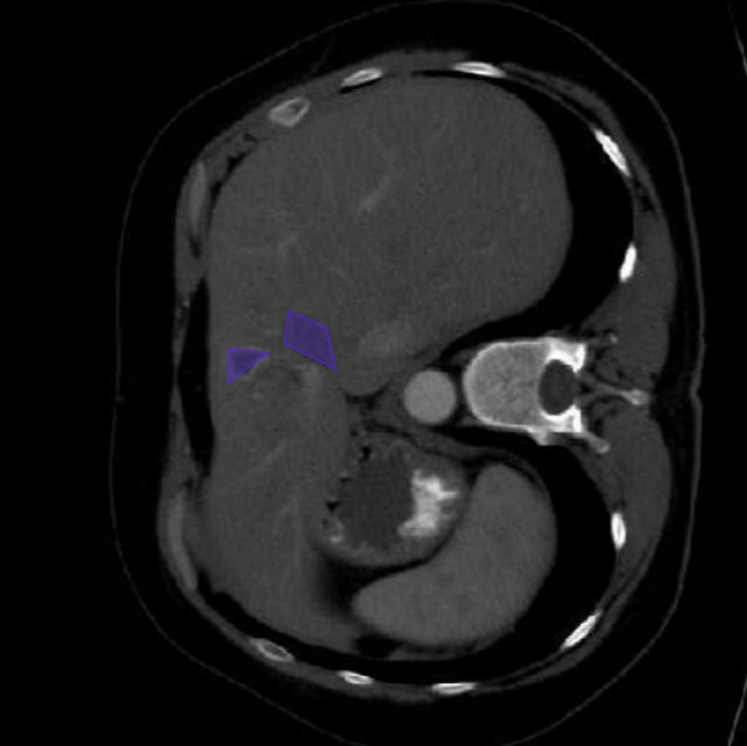 Liver Segmentation Example 1