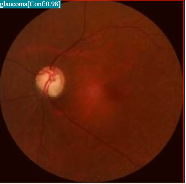Eye Disease Detection Example 1