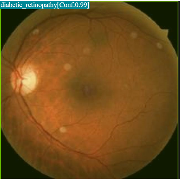 Eye Disease Detection Example 2