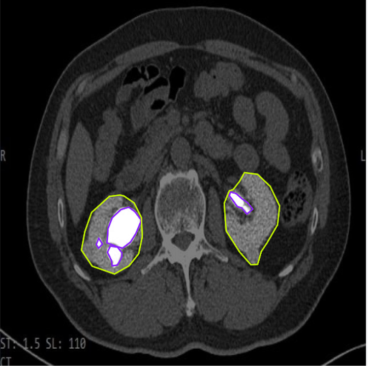 Kidney Tumor Segmentation Example 1