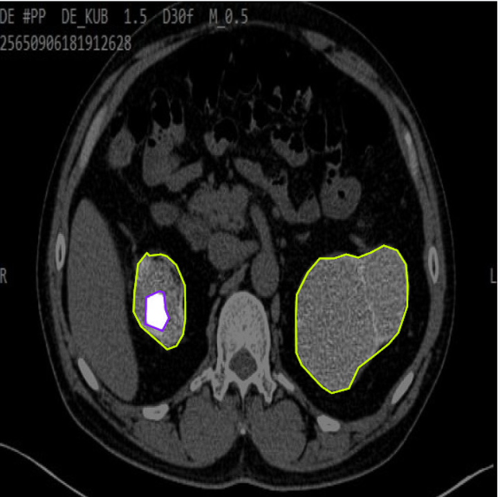 Kidney Tumor Segmentation Example 2