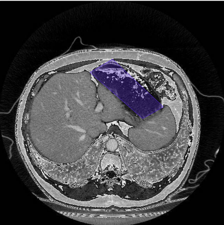 Liver Tumour segmentation