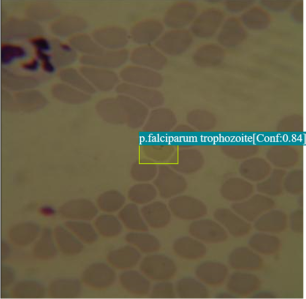 Malaria Parasite Detection Example 2