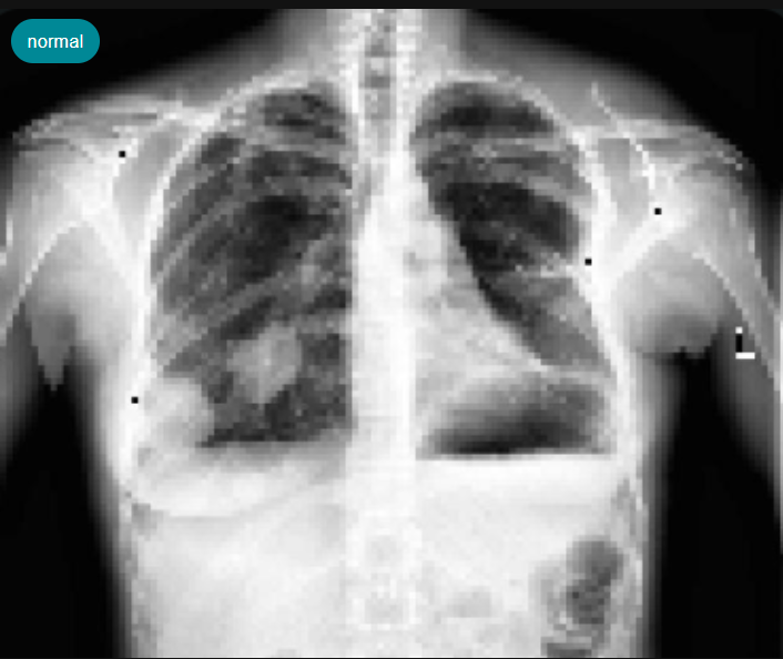 Cardiomegaly_detection_Example1