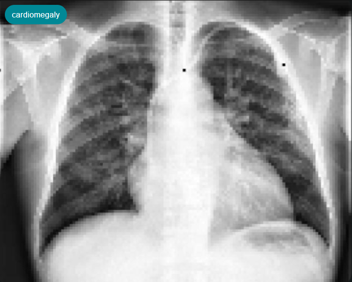 Cardiomegaly_detection_Example1