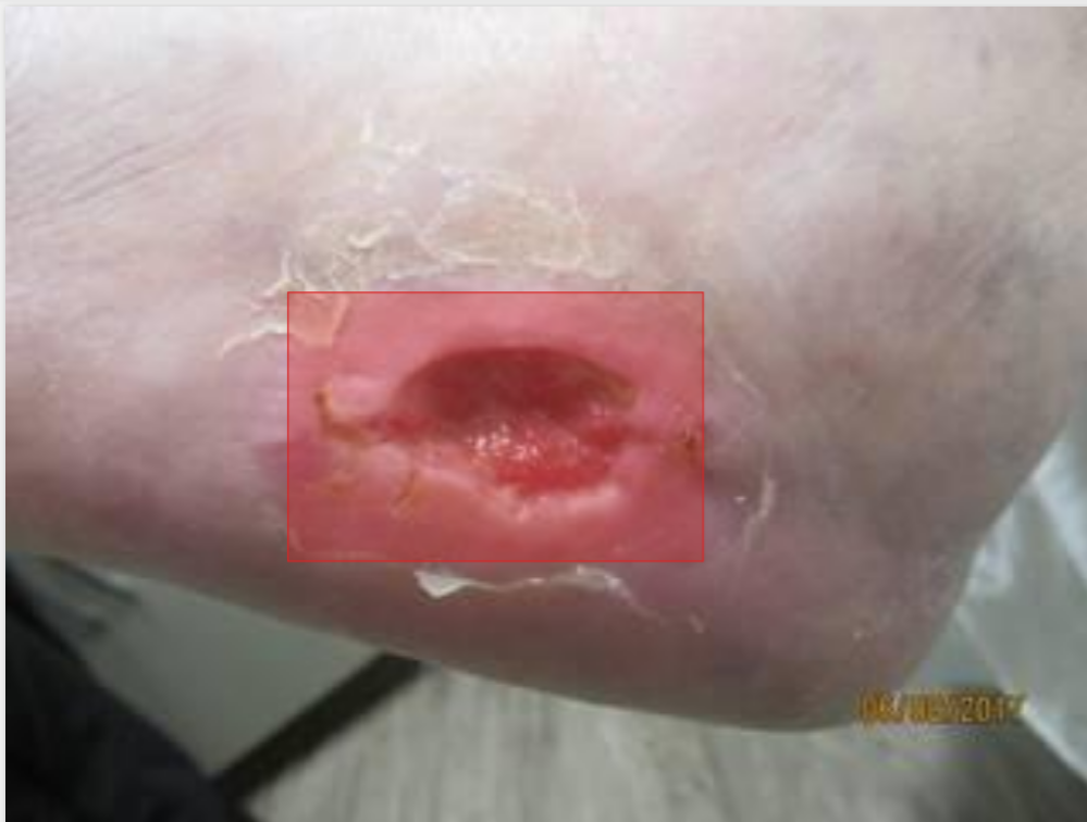 wound segmentation